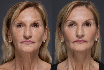 Before After Woman face with brown eyes on grey background | Fillmed