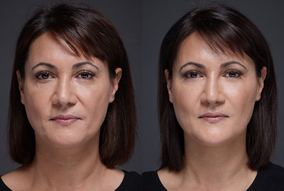 Before After woman face on grey background | Fillmed