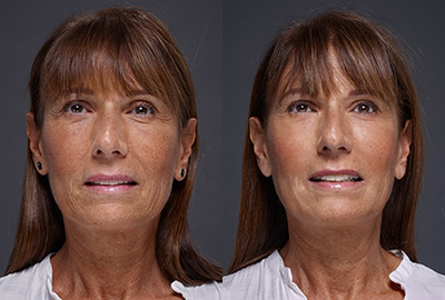 Before After Woman face with brown eyes on grey background | Fillmed