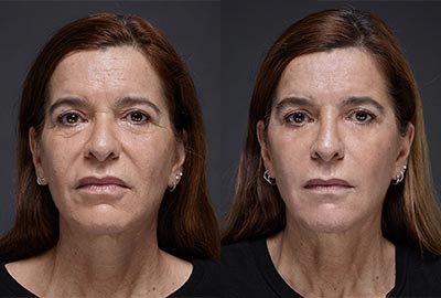 Before After Woman face with brown eyes on grey background | Fillmed