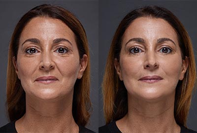 Before After Woman face with brown eyes on grey background | Fillmed