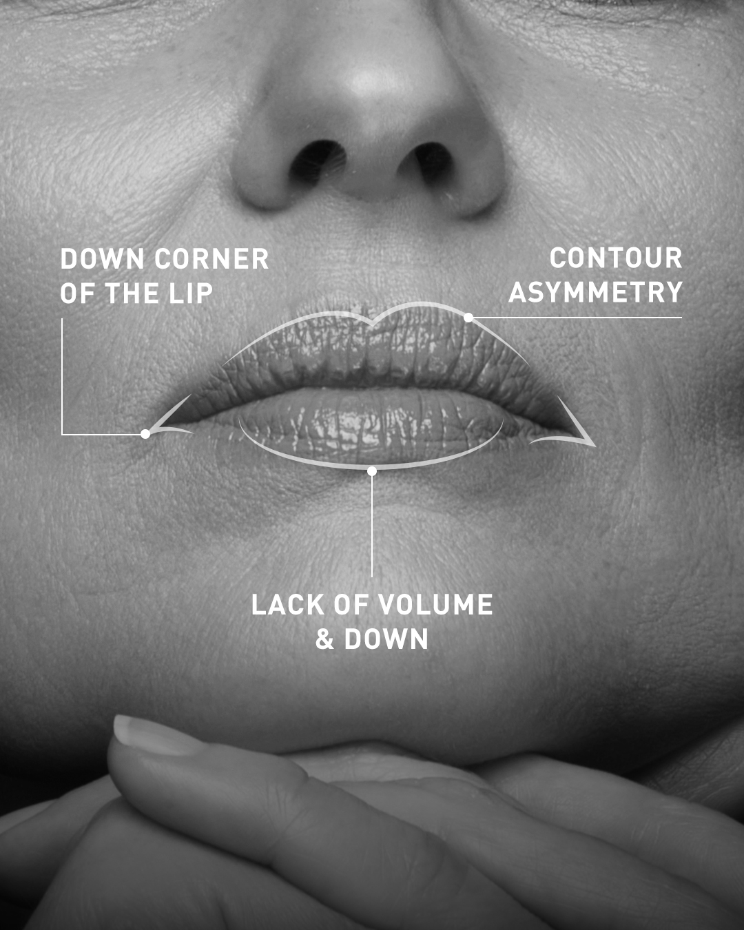 Ageing signs around the mouth Ageing signs around the mouth