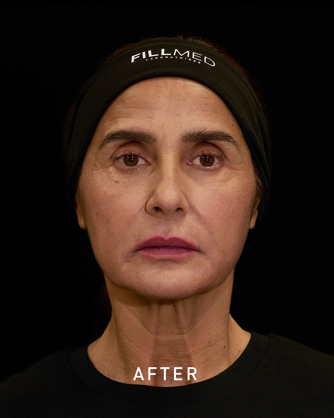 After lips filler treatment photo After lips filler treatment photo