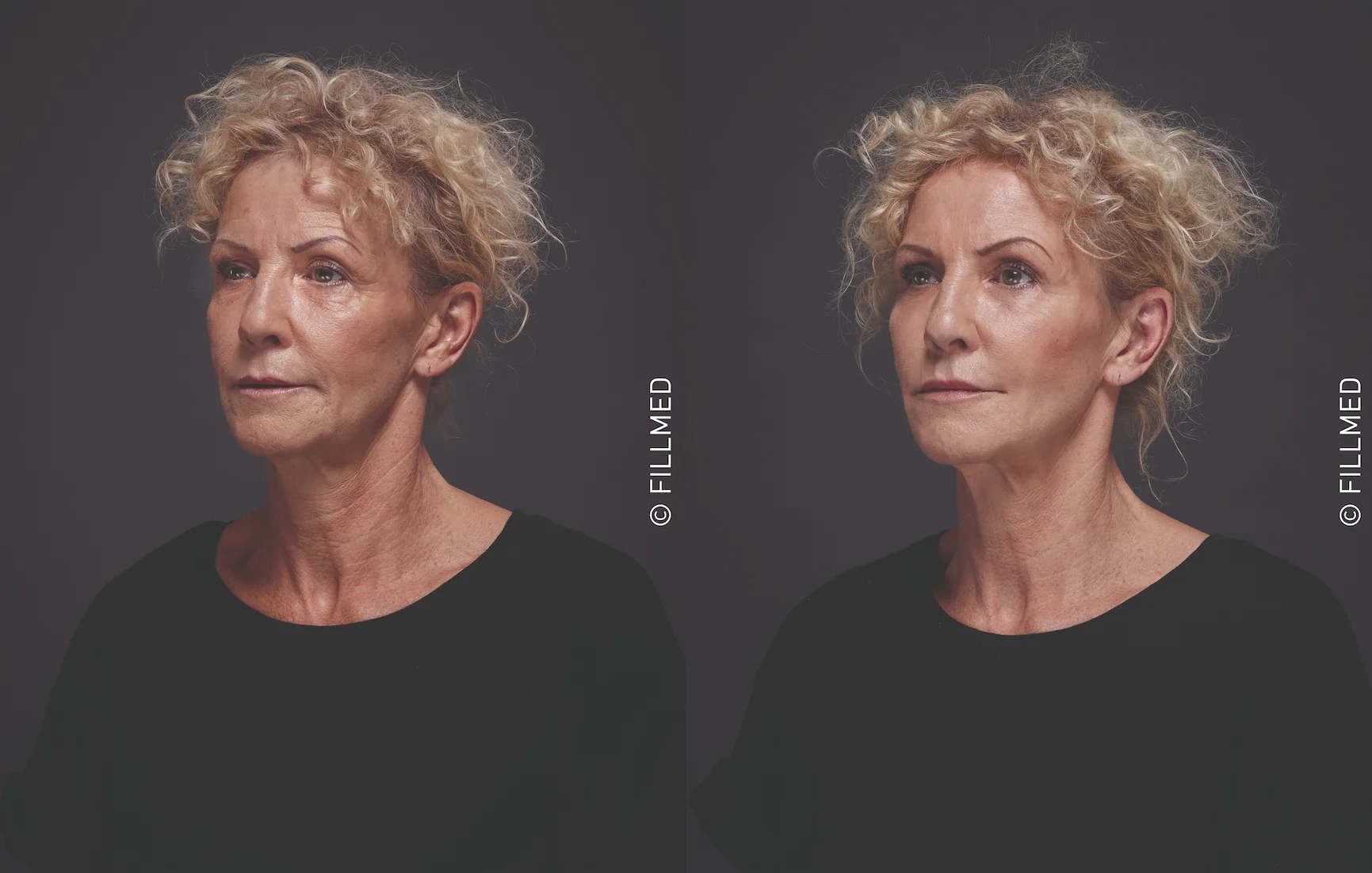 Picture cheek filler before and after Picture cheek filler before and after