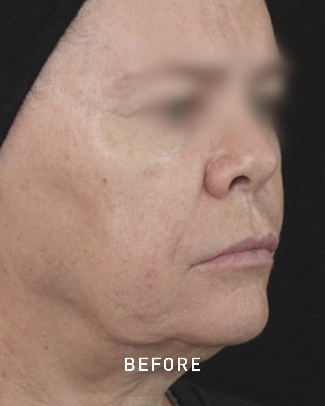 Before jawline filler treatment photo
