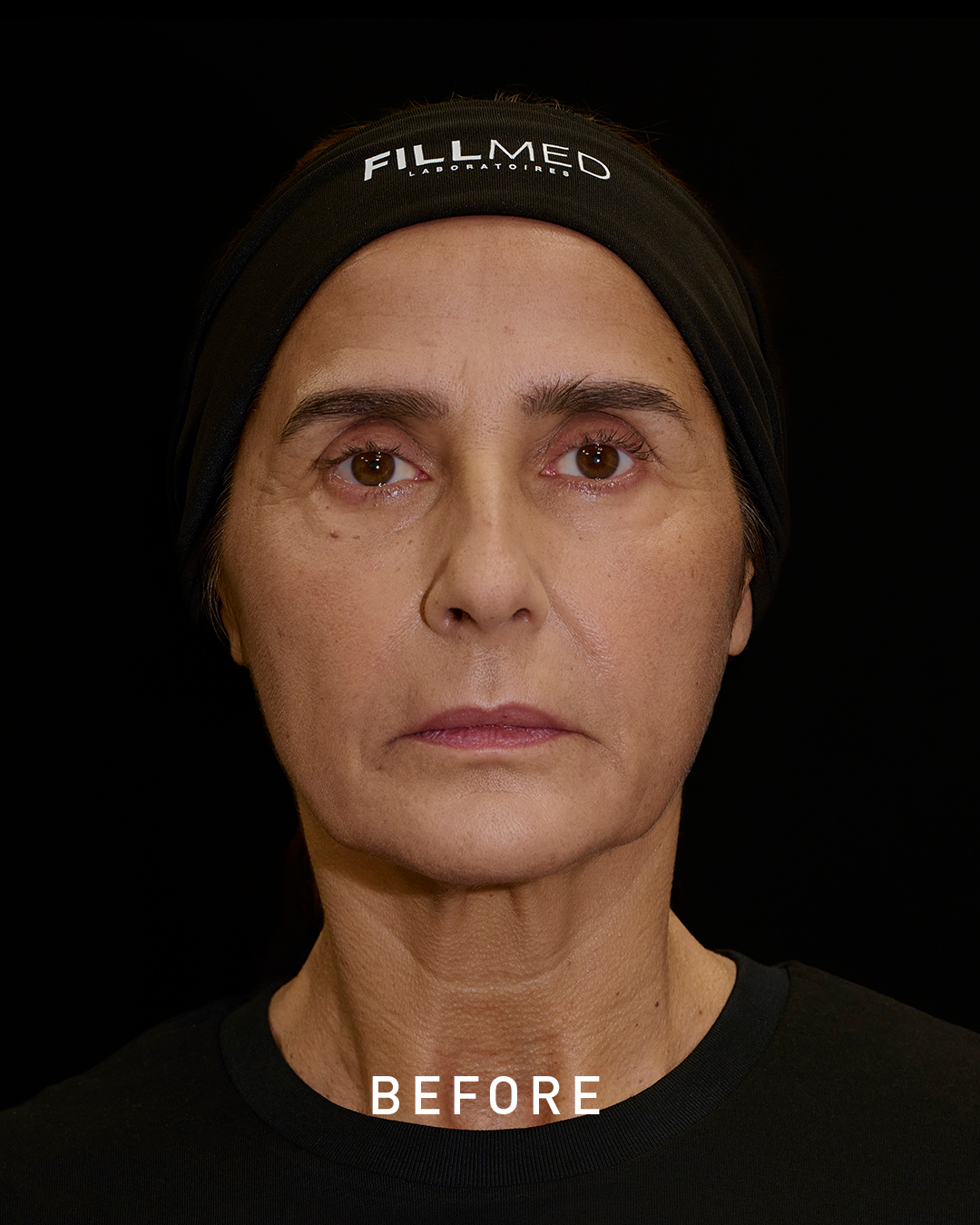 Before lips filler treatment photo Before lips filler treatment photo