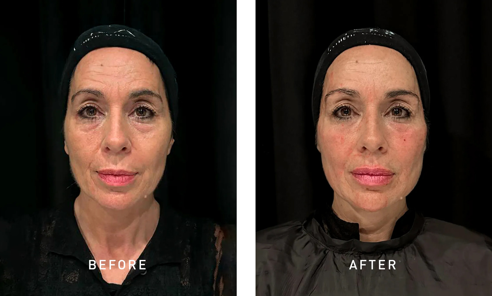 Under-eye area before after hyaluronic acid filler treatment Under-eye area before after hyaluronic acid filler treatment