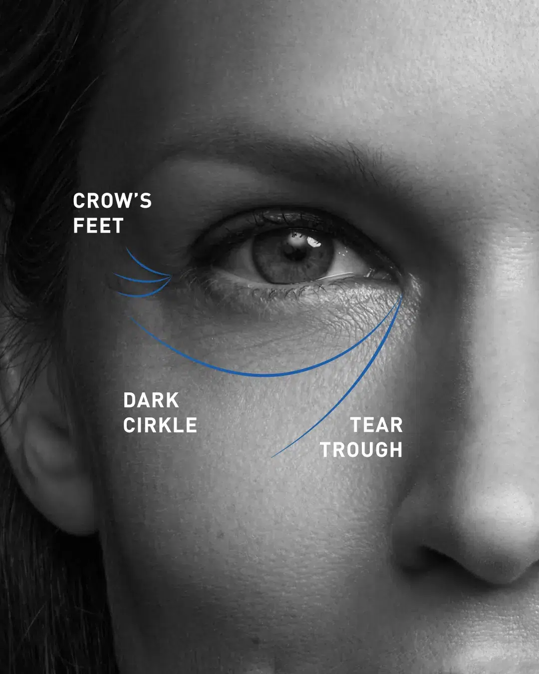 tear trough area under the eye tear trough area under the eye
