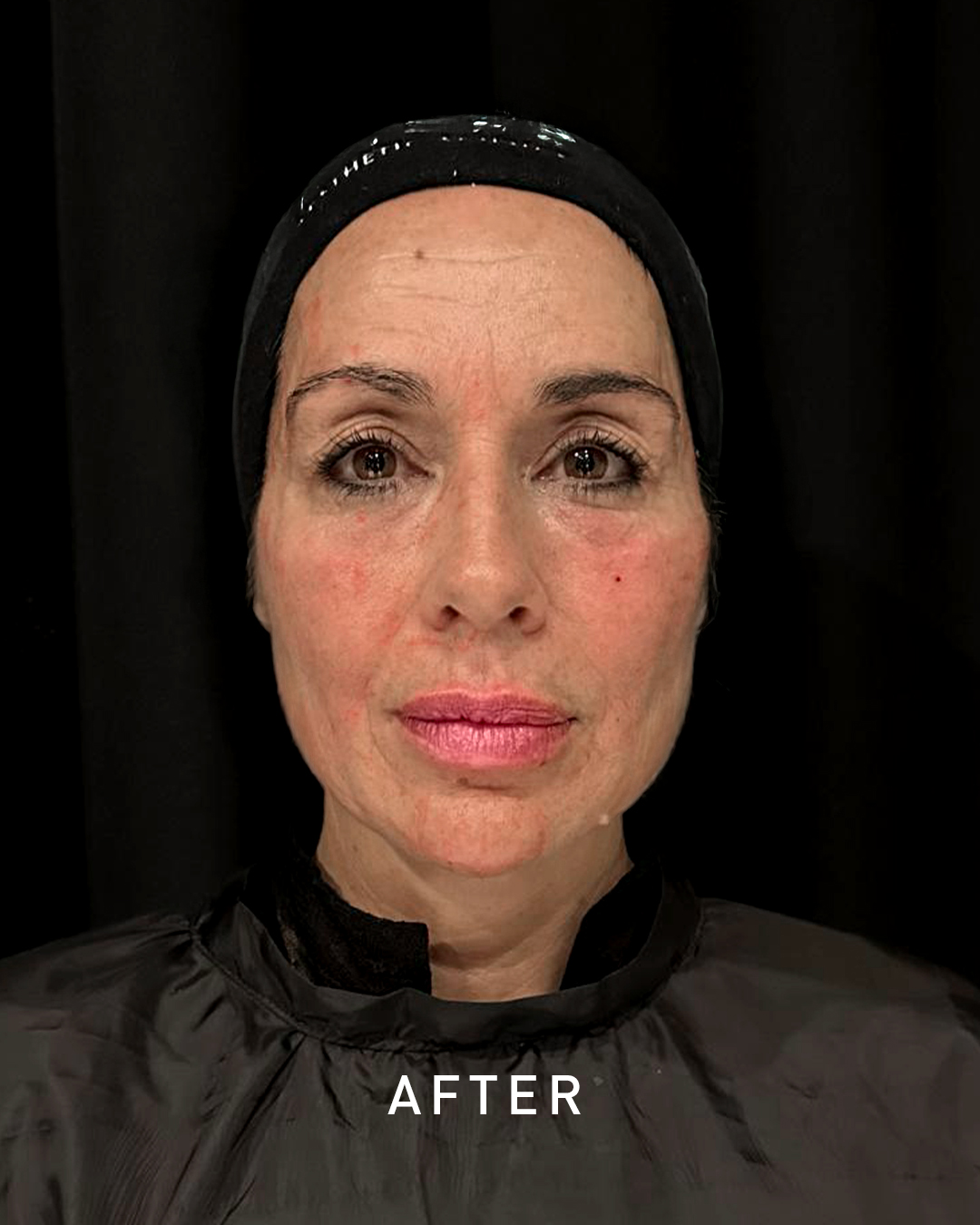 picture of under-eye area after aesthetic eye treatment picture of under-eye area after aesthetic eye treatment